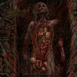 Inherited Production FAECALIZED - CRANIOPAGUS PARASITICUS