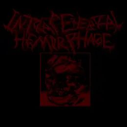 Intracerebral Hemorrhage Intracerebral Hemorrhage